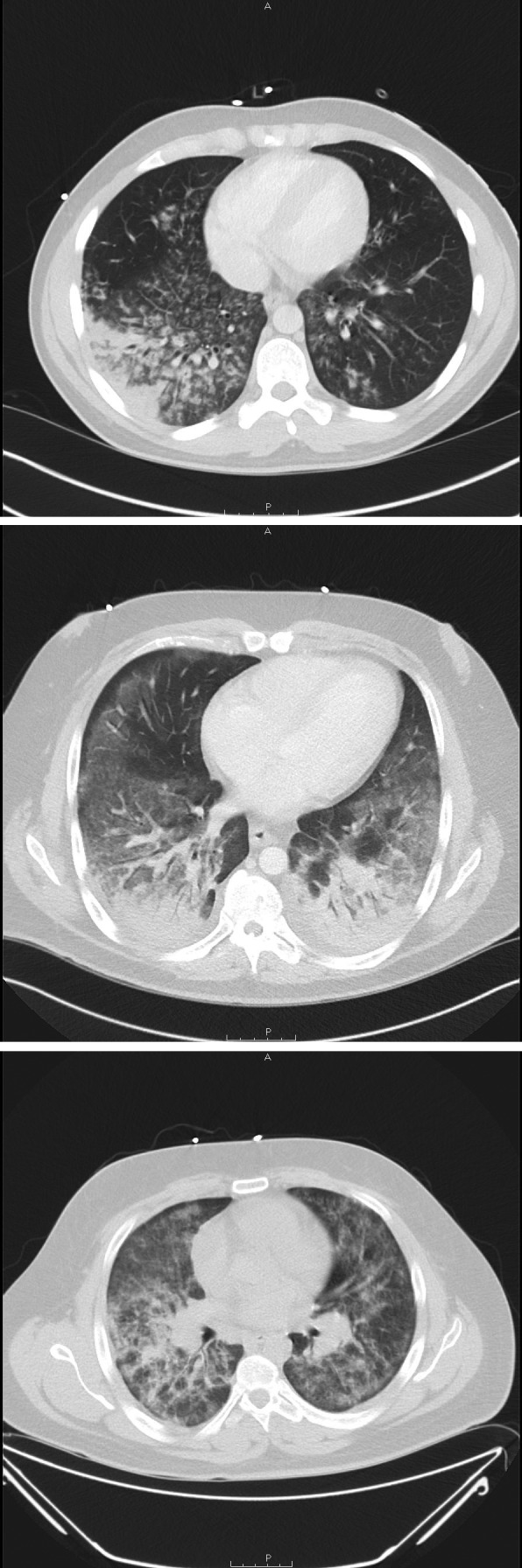 The figure consists of three computerized tomography images showing diffuse lung infiltrates in three patients with e-cigarette–associated severe lung disease in North Carolina, during July–August 2019.