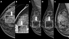 Example of synthetic imaging calcification enhancement in a 43-year-old woman who presented for screening. A, Screening mammogram obtained with synthetic imaging (craniocaudal view). New faint amorphous calcifications are seen in the outer breast. Finding was classified as Breast Imaging Reporting and Data System (BI-RADS) category 0. Inset image was obtained at ×3 magnification. B, Diagnostic mammogram, two-dimensional magnification view (craniocaudal view), confirms the presence of calcifications; however, they are of equal or less conspicuity compared with that seen with synthetic imaging. Inset image was obtained at ×3 magnification. Finding was classified as BI-RADS category 4. C, Screening mammogram obtained with synthetic imaging (mediolateral oblique view). New faint amorphous calcifications are seen in the superior breast. They are less conspicuous compared with those on the craniocaudal view in A. Finding was classified as BI-RADS category 0. Inset image was obtained at ×3 magnification. D, Diagnostic digital mammogram obtained at recall (mediolateral view). Calcifications are much less conspicuous on two-dimensional digital mediolateral view. Inset image was obtained at ×3 magnification. Finding was classified as BI-RADS category 4. E, Diagnostic mammogram obtained with two-dimensional imaging after biopsy (digital mediolateral view). The clip is in appropriate location. Pathologic examination showed ductal carcinoma in situ, intermediate grade.