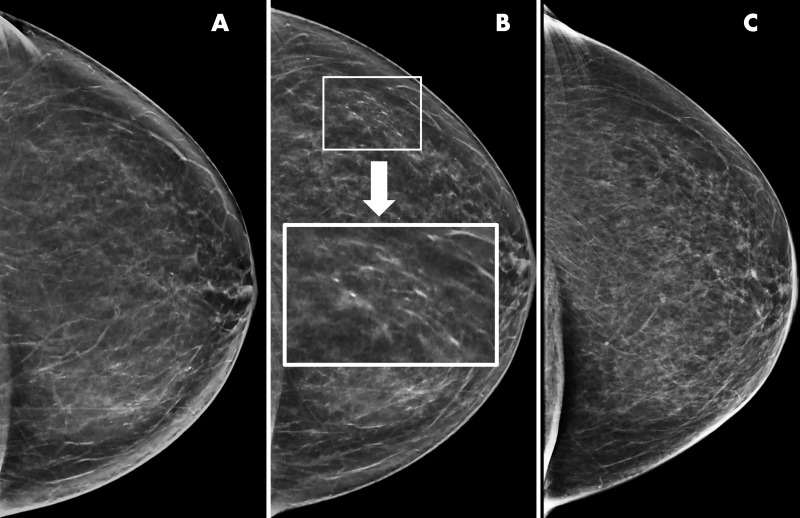 Example of artifactual pseudocalcifications on synthetic images in a 66-year-old woman who presented for screening. A, Screening mammogram obtained with synthetic imaging in 2019 (craniocaudal view). Finding was classified as Breast Imaging Reporting and Data System (BI-RADS) category 1. B, Screening mammogram obtained with synthetic imaging in 2020 (craniocaudal view). New calcifications in a linear distribution are seen in the outer breast. Finding was classified as BI-RADS category 0. Inset image was obtained at ×3 magnification. C, Diagnostic digital mammogram obtained in 2020 (craniocaudal view) reveals no calcifications in the outer breast. Previously seen calcification-like findings represent artifact from enhancement of ligaments or fibroglandular tissue on synthetic reconstruction. Finding was classified as BI-RADS category 1.