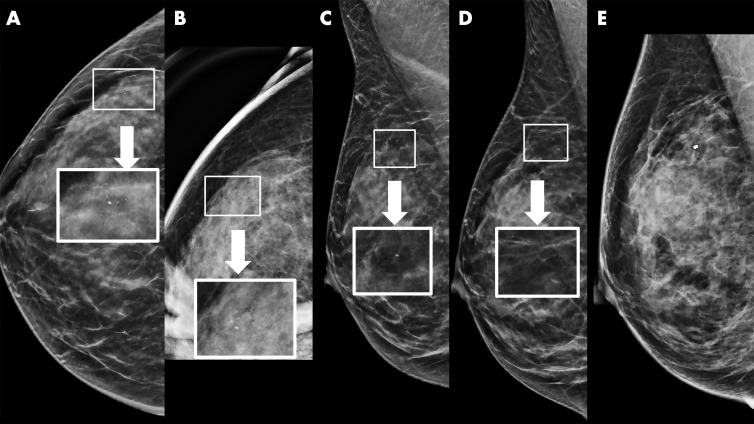 Example of synthetic imaging calcification enhancement in a 43-year-old woman who presented for screening. A, Screening mammogram obtained with synthetic imaging (craniocaudal view). New faint amorphous calcifications are seen in the outer breast. Finding was classified as Breast Imaging Reporting and Data System (BI-RADS) category 0. Inset image was obtained at ×3 magnification. B, Diagnostic mammogram, two-dimensional magnification view (craniocaudal view), confirms the presence of calcifications; however, they are of equal or less conspicuity compared with that seen with synthetic imaging. Inset image was obtained at ×3 magnification. Finding was classified as BI-RADS category 4. C, Screening mammogram obtained with synthetic imaging (mediolateral oblique view). New faint amorphous calcifications are seen in the superior breast. They are less conspicuous compared with those on the craniocaudal view in A. Finding was classified as BI-RADS category 0. Inset image was obtained at ×3 magnification. D, Diagnostic digital mammogram obtained at recall (mediolateral view). Calcifications are much less conspicuous on two-dimensional digital mediolateral view. Inset image was obtained at ×3 magnification. Finding was classified as BI-RADS category 4. E, Diagnostic mammogram obtained with two-dimensional imaging after biopsy (digital mediolateral view). The clip is in appropriate location. Pathologic examination showed ductal carcinoma in situ, intermediate grade.