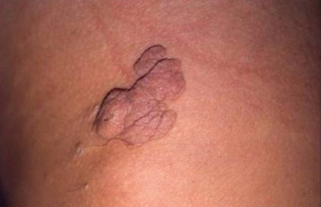 Nevus lipomatosus cutaneous superficialis: Report of eight cases - PMC