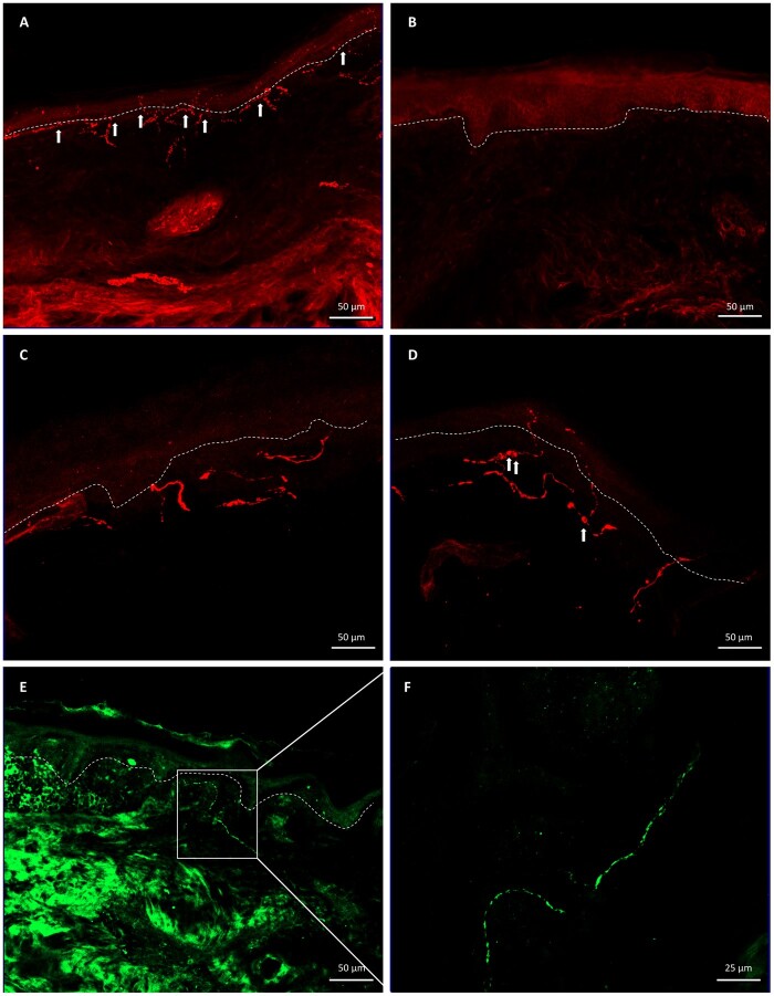 Figure 3 Different skin nerve fibre changes in diabetic neuropathy.