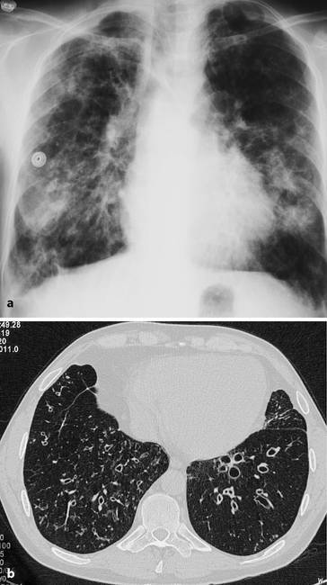 graphic file with name 978-3-642-33108-4_2_Fig24_HTML.jpg