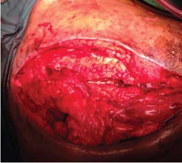 Fig. 4: Shows the lower aspect of the trapezius loosely
suture over the subcutaneous to cover the
implant.