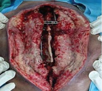Fig. 2: After 1st wound debridement over cervico- thoracic
region with exposed implant.