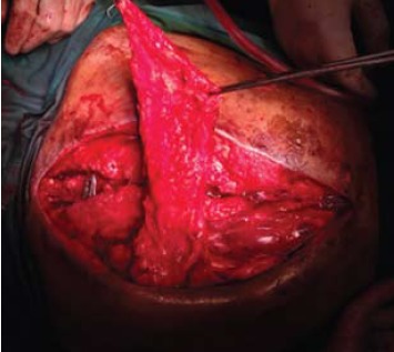 Fig. 3: Shows the lower trapezius dissected from the
spinous process of T12 and rotated superiorly to
close the defect.