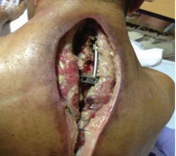 Fig. 1: Wound breakdown with exposed implant over the
cervico- thoracic area.