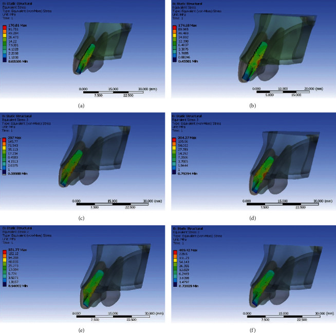 Evaluation Of Stress Generated With Different Abutment Materials And Angulations Under Axial And