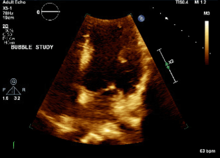 Myocardial Infarction Due To Paradoxical Thromboembolism Originating From Distal Lower Extremity