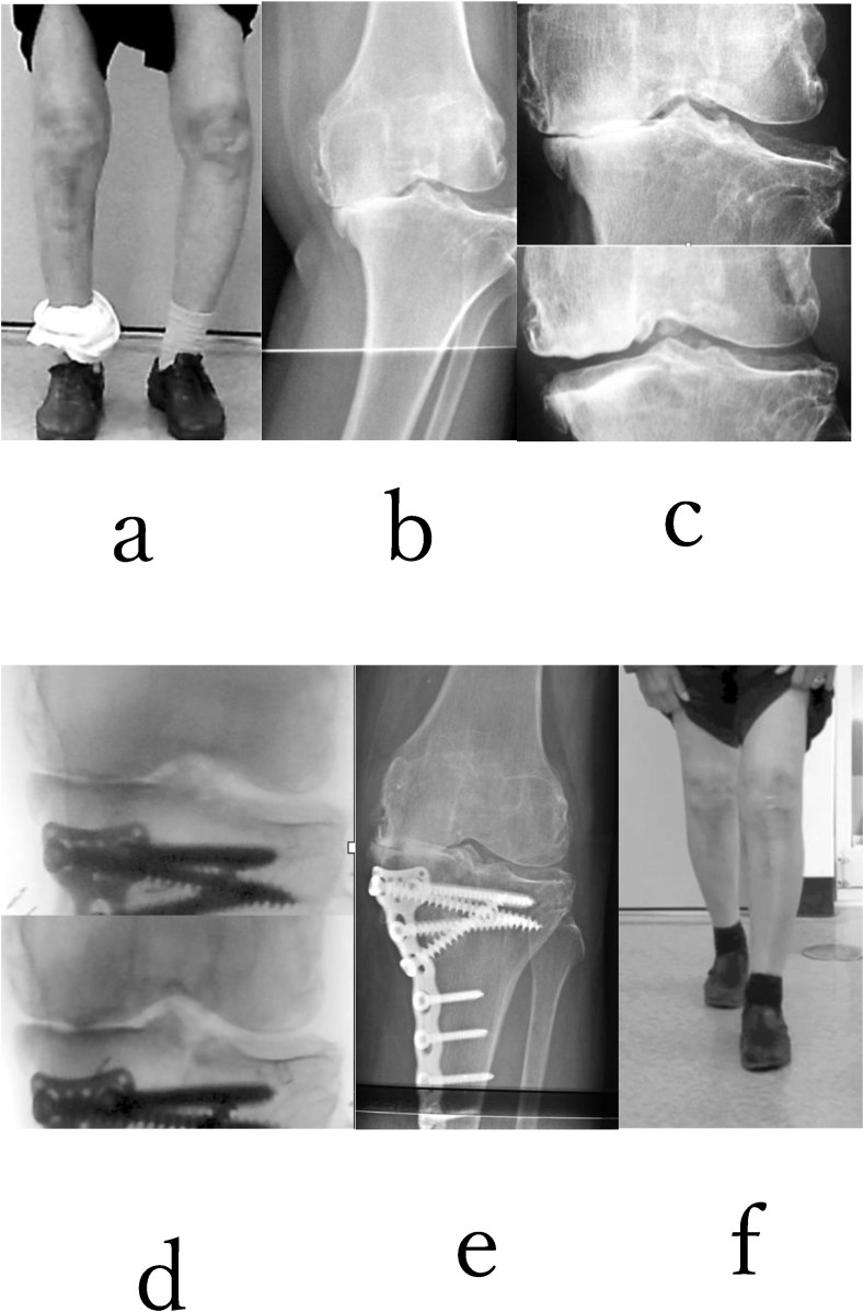 Tibial Condylar Valgus Osteotomy Tcvo Surgical Technique And