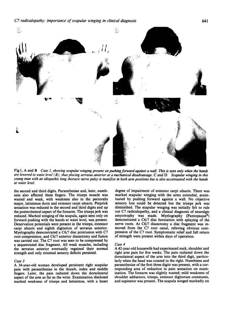 C7 radiculopathy importance of scapular winging in clinical diagnosis