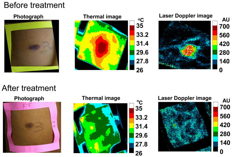 Imaging Techniques for Kaposi Sarcoma (KS) - PMC