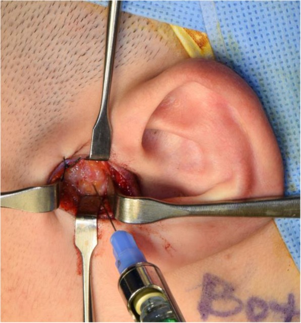 Temporomandibular joint disc plication with MITEK mini anchors