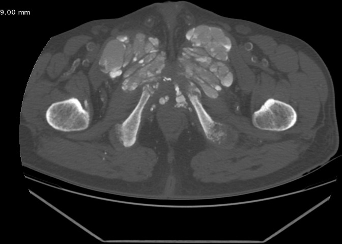 Tumoral Calcinosis Of Unusual Location In A Chronic Hemodialysis 