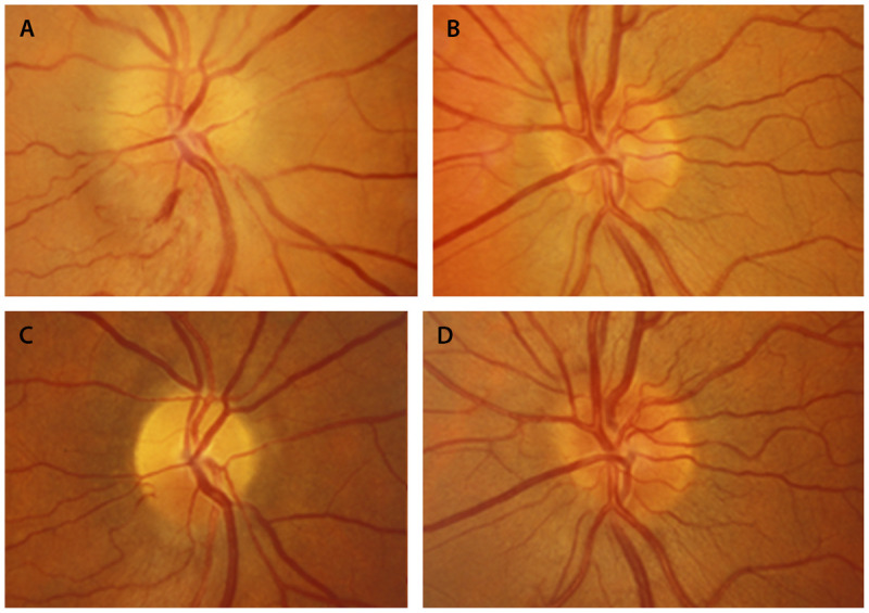 Retinal and Optic Nerve Ischemia - PMC