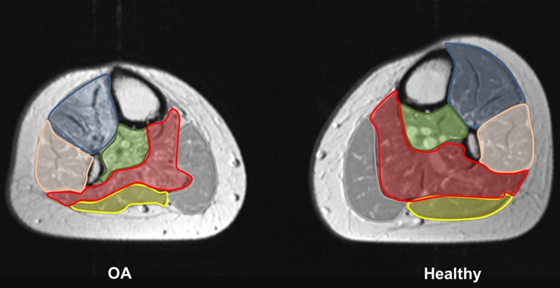 Muscular atrophy of the lower leg in unilateral post traumatic ...