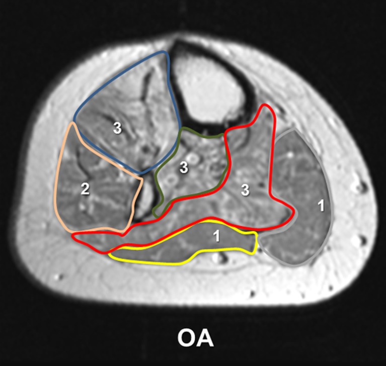 Muscular atrophy of the lower leg in unilateral post traumatic ...