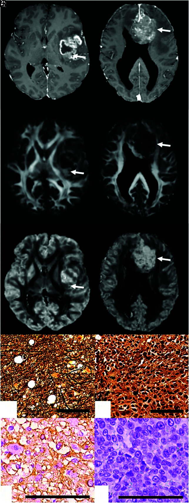 Mesoscopic Assessment of Microstructure in Glioblastomas and Metastases ...