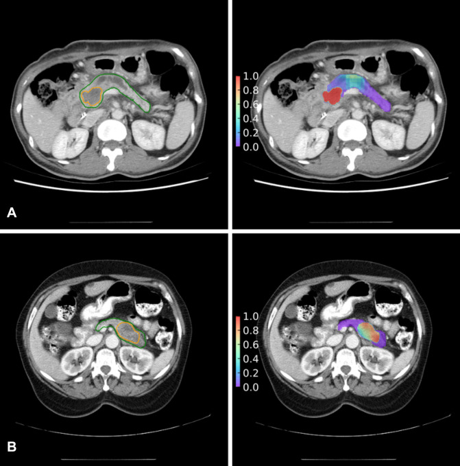 Correspondence in tumor location between model prediction (right panels) and radiologists’ labeling (left panels). Tumors are from the (A) local test set and (B) external test set. Areas encircled in the left panels are the cancer (orange) and pancreas (green) labeled by radiologists. Heatmaps (right panels) are constructed with the probabilities of cancer predicted by the generalized model.