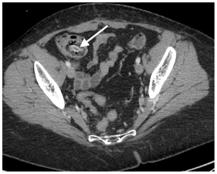 CT diagnosis of appendiceal intussusception in a middle-aged female - PMC