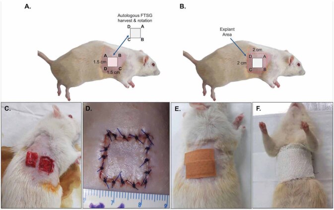 Fig. 1 (A-F). Illustrated photographs of autologous FTSG technique.