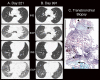 Obstructive chronic lung allograft dysfunction in a 61-year-old man. A, No airtrapping on CT images obtained on posttransplant day 221, with appropriate increased bilateral attenuation on expiratory (EXP) images evolving to, B, severe airtrapping on CT images obtained on posttransplant day 991, manifested by bilateral areas of increasing lucency at expiration. C, At transbronchial biopsy specimen assessment, subepithelial connective tissue (arrows) were apparent in portions of these two membranous bronchioles, identifiable because of their smooth muscle walls (arrowheads on C). Although hemosiderin-containing macrophages can be seen in some airspaces in the lower portion of the biopsy specimen, the alveolar walls are of relatively normal thickness. Bar = 0.5 mm. Additional patient information is found in Tables E1 and E2 (supplement). INS = inspiratory.