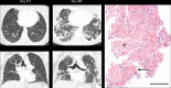 Rapidly progressive restrictive chronic lung allograft dysfunction in a 21-year-old woman. CT images obtained on posttransplant day 371 demonstrate mild focal, slightly nodular interlobular septal thickening in the right upper lobe. Worsening coarse interlobular septal thickening, new patchy bilateral peripheral peribronchovascular and subpleural ground-glass opacities, and nodular consolidation is shown on day 485. Findings are consistent with progressive biapical fibrosis with an organizing pneumonia reaction pattern because of rapidly progressive restrictive chronic lung allograft dysfunction. The transbronchial biopsy specimen shows complete densification by a mixture of arborizing intra-alveolar organizing airspace exudates (*) instead of open alveolar spaces and shows some residual airspace fibrin (arrow), both indicating a phase of organizing subacute lung injury (acute fibrinous and organizing pneumonia). Hematoxylin-eosin staining was used. The horizontal bar is equivalent to 200 µm. Additional patient information is found in Tables E1 and E2 (supplement).
