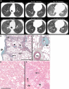 A, Mixed-phenotype chronic lung allograft dysfunction in a 30-year-old man. CT images obtained on posttransplant day 1833 show predominantly peribronchovascular reticulation with nodular thickening of the interlobular septa (ILS), perilymphatic nodules, and associated architectural distortion. The expiratory image obtained on day 1833 demonstrates new moderate airtrapping with a lower-than-expected increase in attenuation and lack of volume reduction. B, Low-power images of the left lower lobe from the explant in A. The pleura (P) shows mild fibrosis. Bands of fibrous tissue, presumably the residua of unresolved organizing pneumonia, extend from the subpleural zone and penetrate the underlying parenchyma following the ILS (arrows). Some of the centrilobular airways demonstrate changes of constrictive obliterative bronchiolitis (arrowheads). Movat pentachrome staining is used. The horizontal bar is equivalent to 2 mm. C, From a different area of the left lower lobe, this medium-power micrograph of a membranous bronchiole (Br) demonstrates the classic finding of constrictive obliterative bronchiolitis, in which the subepithelial zone, of normal to negligible thickness, is expanded by a myofibroblastic matrix (double arrow), causing a severe reduction in luminal patency. Movat pentachrome staining is used. The horizontal bar is equivalent to 0.5 mm. D, Microscopic section from a chronic lung allograft dysfunction explant shows uniform alveolar wall thickening and architectural sparing changes of nonspecific interstitial pneumonia. The airspaces contain scattered inflammatory cells and occasionally contain some edematous fluid. The horizontal bar is equivalent to 0.5 mm. E, Superimposed on a background of nonspecific interstitial pneumonia, the parenchyma shows a combination of alveolar macrophage accumulation, simulating a desquamative interstitial pneumonia pattern (*) with airspace cholesterol granulomas (arrow), suggesting a component of obstructive pneumonitis. Some of the tissue compaction is likely due to atelectasis. Hematoxylin-eosin staining is used. Additional patient information is found in Tables E1 and E2 (supplement). ils = interlobular septal thickening, PA = pulmonary artery.