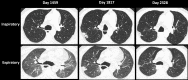 Mixed-phenotype chronic lung allograft dysfunction in a 37-year-old man. CT studies obtained on posttransplant days 1817 and 2328 show worsening bilateral airtrapping manifested by a lower-than-anticipated decrease in volume and increased attenuation at expiration. CT images obtained on day 1817 show new focal peripheral consolidation in the posterior right upper lobe, which decreases in extent but fails to resolve on day 2328. Worsening volume loss and associated retraction of the oblique fissure is shown on images obtained on day 2328. Additional patient information is found in Tables E1 and E2 (supplement).