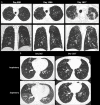A, Mixed-phenotype chronic lung allograft dysfunction in a 33-year-old woman. CT images obtained on posttransplant day 808 show patchy subpleural consolidation and ground-glass opacities in the right upper lobe. CT images obtained on day 1286 show right upper lobe–predominant patchy ground-glass opacities and subpleural reticulation with volume loss. CT images obtained on day 1617 show progressive bilateral apical pleural thickening, subpleural fibrosis with traction bronchiectasis, volume loss, and architectural distortion, which are consistent with pleuroparenchymal fibroelastosis. B, CT images obtained on day 362 show right-middle-lobe airtrapping because of bronchial stenosis (not shown). CT images obtained on day 1557 show bilateral bronchiectasis and markedly worse bilateral airtrapping, evidenced by a lower-than-normal increase in attenuation and a lack of volume reduction, which are consistent with deteriorating accompanying obstruction. Additional patient information is found in Tables E1 and E2 (supplement).