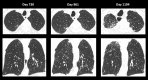 Restrictive chronic lung allograft dysfunction in a 58-year-old man. CT images obtained on posttransplant day 730 show subpleural patchy consolidation and ground-glass opacities in the posterior right upper lobe, which increases on day 961, with subsequent progressive worsening of interlobular septal thickening, pleuroparenchymal consolidation, fissural retraction, and volume loss in the right upper lobe, with similar but less marked changes in the left upper lobe at day 1194. Additional patient information is found in Tables E1 and E2 (supplement).