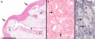 Representative images of pathologic patterns that can be seen in restrictive chronic lung allograft dysfunction. A, Scanned microscopic section from pleuroparenchymal fibroelastosis that shows the classic subpleural band of fibroelastosis with sharp demarcation from the deeper lung parenchyma (arrows). There are lumina of ectatic, caliber-persistent airways (*) as they extend toward and into the subpleural fibroelastotic zone. Pulmonary artery is shown (★). The horizontal bar is equivalent to 5 mm. Hematoxylin-eosin staining was used. B, Magnified image shows the typical picture of pleuroparenchymal fibroelastosis with partially preserved, thickened alveolar wall elastica (arrows) encircling airspaces filled with inert organized fibrosis. Hematoxylin-eosin staining was used. C, In this micrograph, the elastic tissue is highlighted in black (arrows), enclosing old organizing collagenous alveolar exudates (*). Movat pentachrome staining was used. Additional patient information is found in Tables E1 and E2 (supplement).