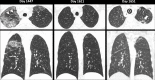 Mixed-phenotype chronic lung allograft dysfunction in a 26-year-old woman. CT images obtained on posttransplant day 1447 demonstrate a multifocal bilateral upper lobe and peripherally predominant peribronchovascular ground-glass opacities and interlobular septal thickening (arrowheads), accompanied by elevated bronchoalveolar lavage and peripheral blood eosinophilia consistent with an eosinophilic pneumonia pattern, which resolves at follow-up CT on day 1611. CT images obtained on day 1651 demonstrate increased bronchial wall thickening and new multifocal peripheral consolidation with a reverse halo sign (arrow), in keeping with the organizing pneumonia pattern in the apicoposterior segment of the left upper lobe. Additional patient information is found in Tables E1 and E2 (supplement).