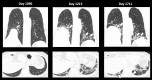 Restrictive chronic lung allograft dysfunction in a 48-year-old woman. CT images obtained on posttransplant day 1213 show basal predominant sweeping peribronchovascular and perilobular consolidation and ground-glass opacities, in keeping with an organizing pneumonia reaction pattern, with worsening traction bronchiectasis (arrows) and volume loss on images obtained on day 1711. Elevation of the right hemidiaphragm contributes to volume loss with diaphragmatic paralysis, a known posttransplant complication. Additional patient information is found in Tables E1 and E2 (supplement).