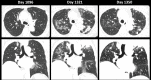 Mixed-phenotype chronic lung allograft dysfunction in a 68-year-old man. CT images obtained on posttransplant day 1096 demonstrate nodular subpleural consolidation in the apical right upper lobe (arrow). CT images obtained on day 1321 show new upper lobe–predominant perilobular ground-glass opacities and dense consolidation with associated bronchial dilatation and volume loss, as well as an organizing pneumonia reaction pattern with improved but persistent findings on images obtained on day 1350 (arrowheads). Additional patient information is found in Tables E1 and E2 (supplement).