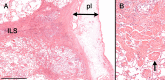 Hematoxylin-eosin–stained section from a lung at autopsy in a patient with chronic lung allograft dysfunction (imaging not available). A, Scanned micrograph shows typical features of acute fibrinous and organizing pneumonia (AFOP) associated with organizing alveolar fibroelastosis. The changes are distributed on both sides of an interlobular septum (ILS) in a perilobular pattern. Fibrinous pleuritis with edema has widened the pleura (pl). The horizontal bar is equivalent to 1.25 mm. B, Higher-magnification image of the region of AFOP shows compact fibrin balls occupying alveolar spaces (arrow) that can be seen separating away from the alveolar septa.