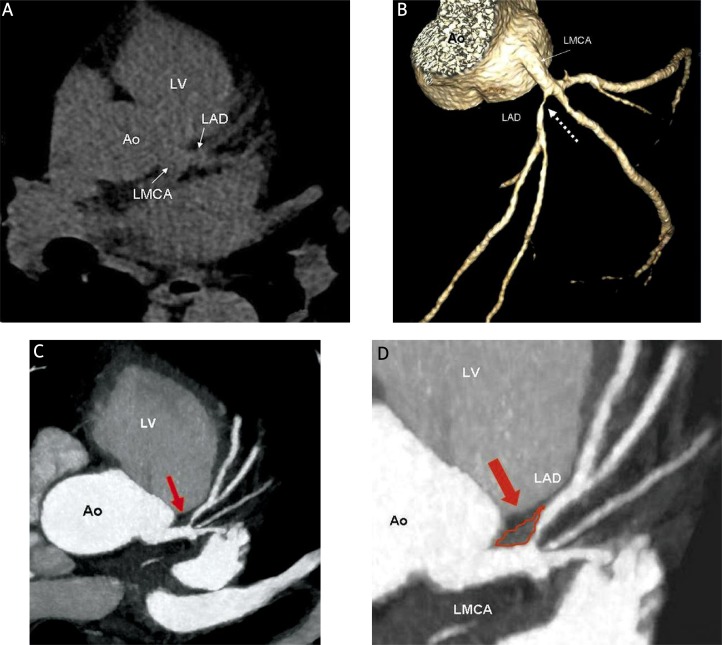 Ryc. 3. Indeks CAC zero (brak zwapnień w tętnicach wieńcowych) oraz istotne zwężenie proksymalnego odcinka LAD zobrazowane w angiografii CCT. Indeks CAC zero (A). Obecność istotnego zwężenia proksymalnego odcinka LAD w wielopłaszczyznowej rekonstrukcji obrazu (B, biała strzałka wykropkowana) u pacjenta z indeksem CAC zero (nieuwapniona blaszka miażdżycowa) (C, D – czerwona strzałka)