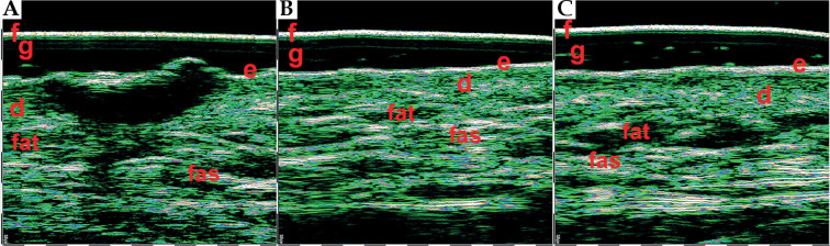 The use of high frequency skin ultrasound in non-melanoma skin cancer - PMC