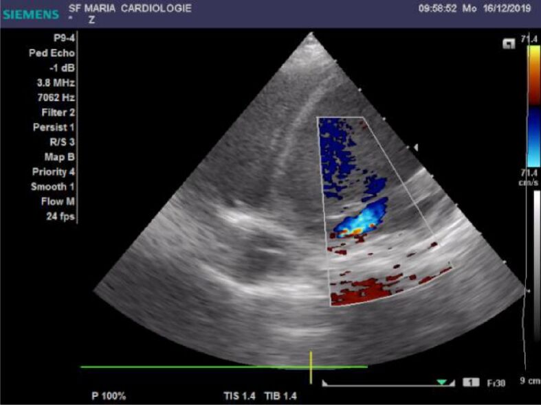 Endocardial fibroelastosis and dilated cardiomyopathy – the past and ...