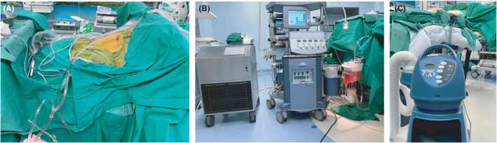 Better Effect Of Intrapleural Perfusion With Hyperthermic Chemotherapy 