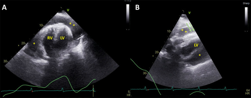 TTE apical 4-chamber and subcostal views show large pericardial effusion with RV diastolic collapse