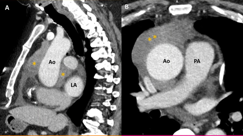 Contrast-enhanced chest CT shows hyperintense lobulated anterior mediastinal mass encasing aorta and extending to left atrium