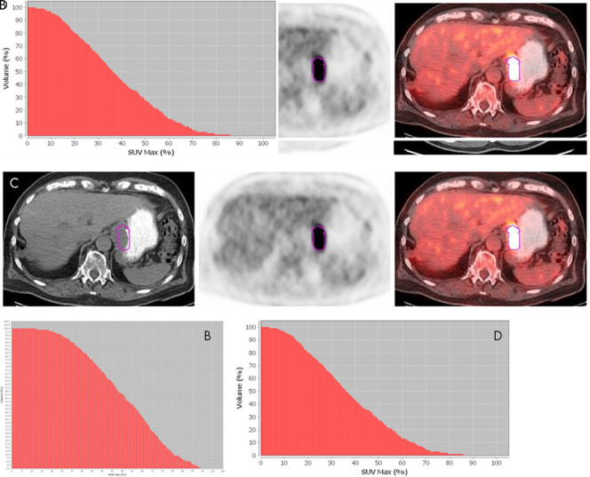 A, Axial 18F fluorodeoxyglucose (18F-FDG) PET/CT images in a 55-year-old man with stage III moderately differentiated adenocarcinoma (outlined in purple), with maximum standardized uptake value (SUVmax) of 9.54, metabolic tumor volume (MTV) of 19.12 mL, area under the curve of cumulative standardized uptake value volume histogram (AUC-CSH) of 6458, and a large area under the curve, corresponding to low IMH, B. This patient survived for 91 months after diagnosis. C, Axial 18F-FDG PET/CT images in an 80-year-old man with stage III moderately differentiated adenocarcinoma, with a higher SUVmax of 20.4 and slightly higher MTV of 22.45 mL (compared with the patient in A and B), D, but a lower AUC-CSH of 4805 (significantly smaller area under the curve), corresponding to high IMH. This patient survived for 60 months after diagnosis.