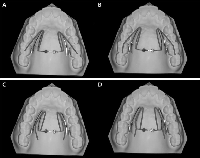 Figure 3. . Lingual arch type midpalatal miniscrews connecting wire. (A) Nonparallel type expansion. (B) Parallel type expansion activation. (C) Nonparallel type constriction activation. (D) Parallel type constriction activation.