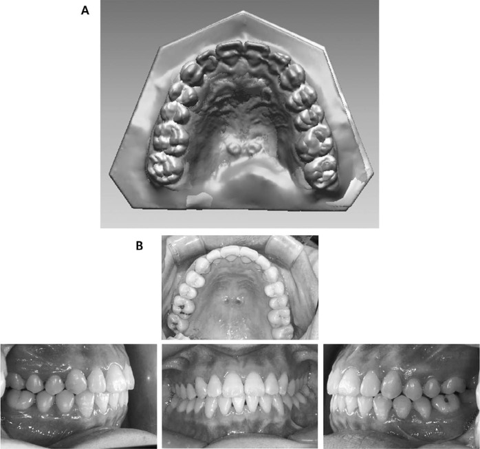 Figure 10. . Case 2 after treatment. (A) Superimposition of 3D models before and after treatment (yellow: before treatment, green: after treatment). (B) Intraoral photos after completion of treatment.