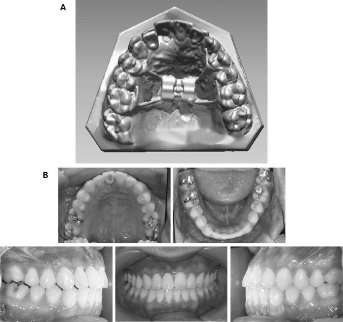 Figure 6. . Case 1 after treatment. (A) Superimposition of 3D models before and after treatment (yellow: before treatment, green: after treatment). (B) Intraoral photos after completion of treatment.