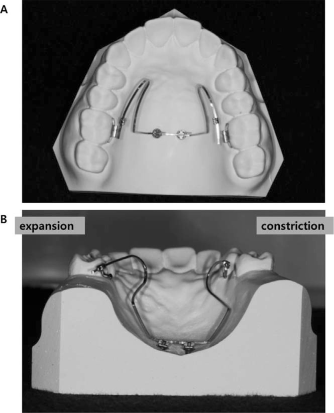 Figure 2. . Lingual arch type midpalatal miniscrews connecting wire. (A) Occlusal view of the appliance with the wires inserted into the lingual sheath of the first molars. (B) Coronal view from the posterior side of wire activated.