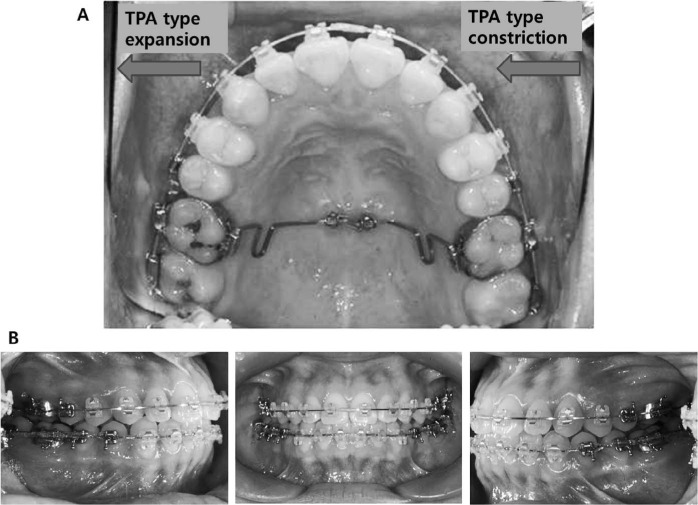 Figure 9. . Case 2 during treatment. (A) Transpalatal arch-type midpalatal miniscrew connecting wire for asymmetric transverse control of maxillary dentition. Right side was expanded and left side was constricted. (B) Intraoral photos during treatment.