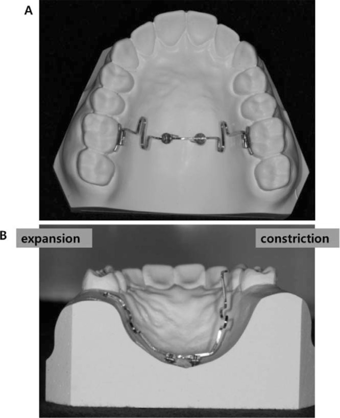 Figure 1. . Transpalatal arch-type midpalatal miniscrews connecting wire. (A) Occlusal view of the appliance with the wires inserted into the lingual sheath of the first molars. (B) Coronal view from the posterior side of wire activated.