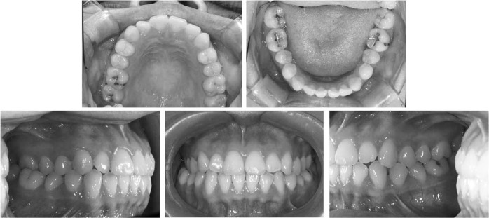 Figure 8. . Pretreatment intraoral photo of case 2.